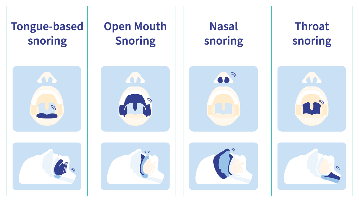 Stop snoring What causes snoring and how to stop it