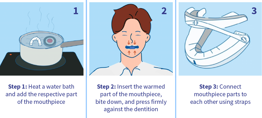 Fitting a snoring mouth guard