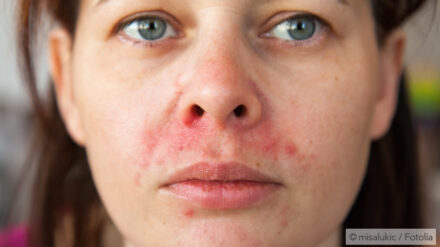 How to Avoid CPAP Mask Skin Irritation and Pressure Sores – When Your CPAP Mask Digs In and Chafes